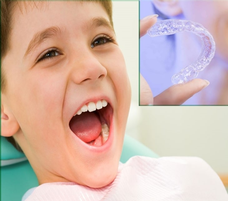 Niềng răng Invisalign là phương pháp có tính thẩm mỹ cao