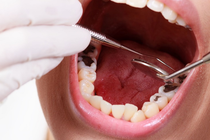 Nhổ răng sâu là hình thức điều trị sâu răng  cuối cùng cho bệnh nhân