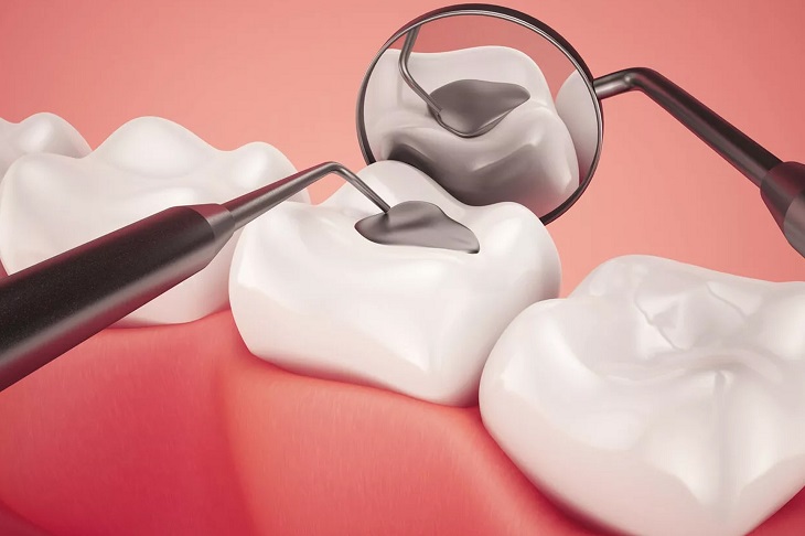 Phương pháp hàn trám răng dùng cho mọi đối tượng khác nhau