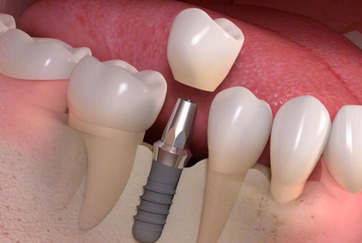 Trồng răng là một giải thẩm mỹ hàm răng được nhiều người tìm hiểu hiện nay