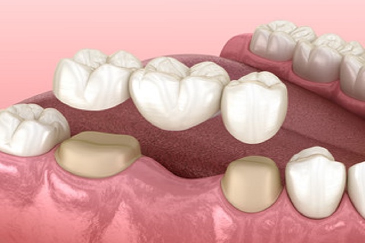 Làm cầu răng sứ đòi hỏi răng trụ xung quanh cần khỏe mạnh và cứng cáp