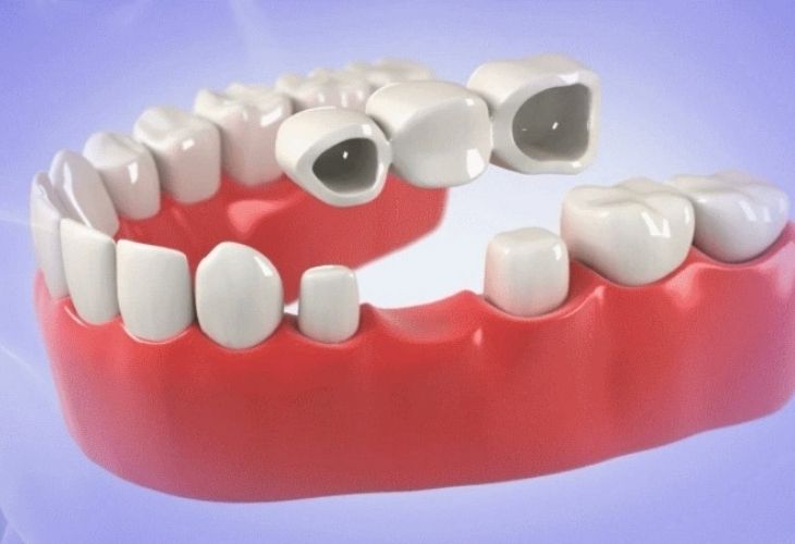 Làm răng bắc cầu giúp phục hồi chức năng ăn nhai của răng đã mất