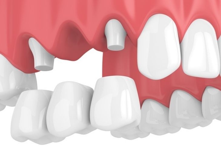 Quy trình làm răng bắc cầu khá đơn giản và ít phức tạp hơn so với làm răng Implant