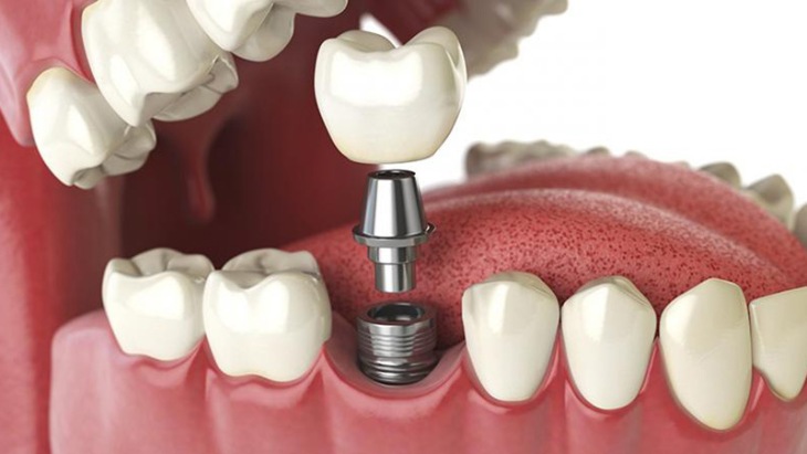Phương pháp trồng răng cấm implant được nhiều người lựa chọn
