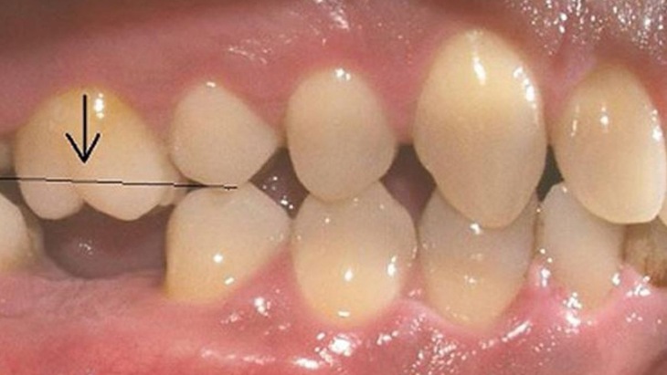 Răng cấm là răng số 6 cần được trồng thay thế ngay khi mất