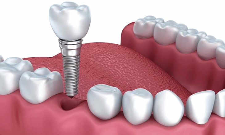 Chi phí trồng răng bằng phương pháp cắm implant cao hơn so với các phương pháp khác