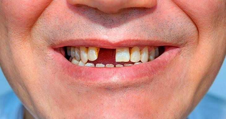 Trồng răng cửa là điều cần thiết để đảm bảo chức năng ăn nhai cũng như thẩm mỹ gương mặt