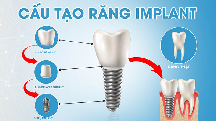 Cấu tạo một răng Implant