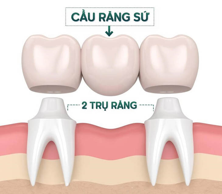 Bắc cầu sứ là phương pháp được nhiều người lựa chọn vì giá cả phải chăng