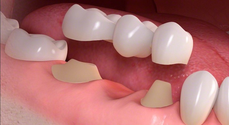 Cầu răng sứ đòi hỏi 2 răng kế cận vùng răng mất phải khỏe mạnh, chắc chắn