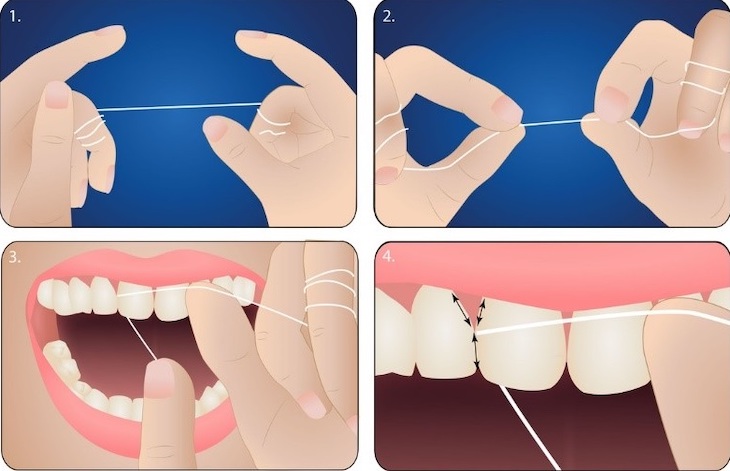 Bên cạnh đánh răng, bạn nên sử dụng thêm chỉ nha khoa giúp làm sạch kẽ răng