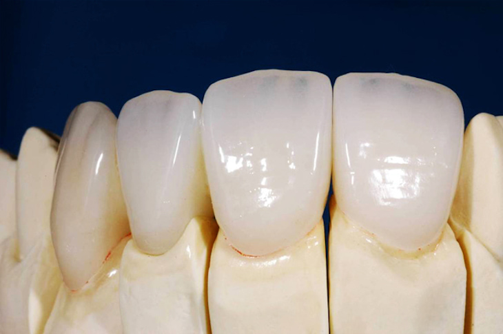 Số lượng răng cần trồng có ảnh hưởng trực tiếp đến chi phí thực hiện