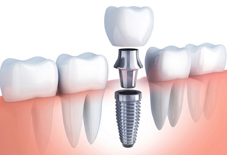 Cắm Implant là phương pháp phục hình răng bền vững, hiệu quả