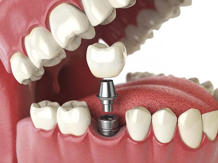 Trồng răng hàm dưới khi bị mất là điều cần thiết