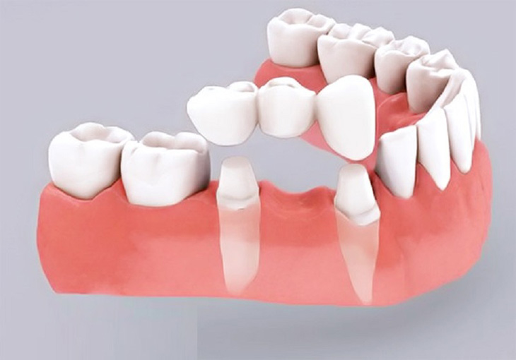 Bắc cầu răng sứ khôi phục răng hàm đã mất được nhiều người lựa chọn