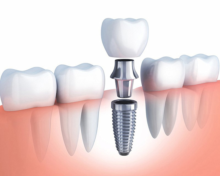 Cắm Implant là phương pháp khôi phục răng hàm dưới hiệu quả, lâu bền