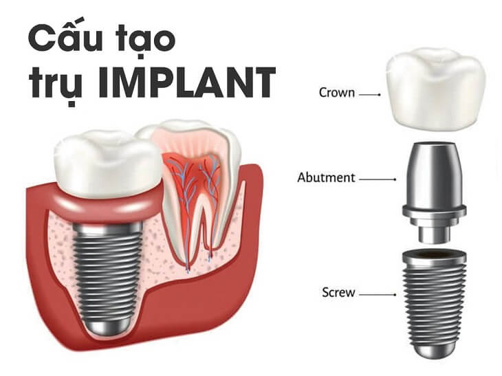 Cấu tạo chung của một răng Implant