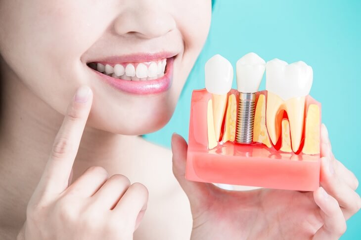 Trồng răng Implant giúp bạn tự tin hơn