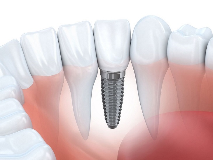 Trồng răng implant là phương pháp được nhiều người sử dụng hiện nay