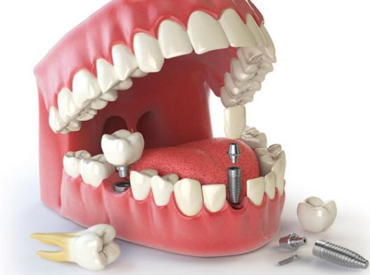 Để đạt được hiệu quả trồng răng cần làm theo đúng quy trình