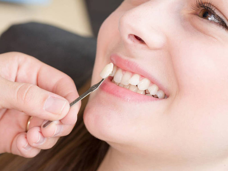 Trồng răng khểnh giá bao nhiêu phụ thuộc nhiều vào phương pháp thực hiện