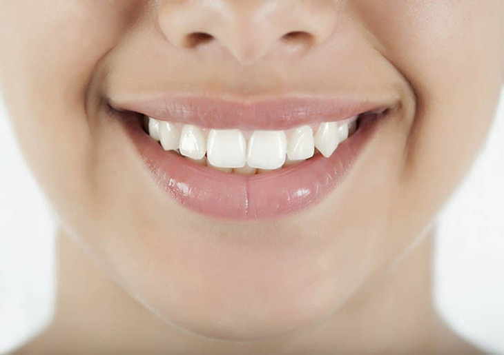 Cầu răng sứ là kỹ thuật hiện đại, nhiều ưu điểm nên giá cũng khá cao