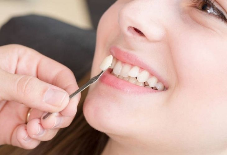 Trồng răng khểnh hiện là xu hướng thẩm mỹ nha khoa được nhiều người quan tâm