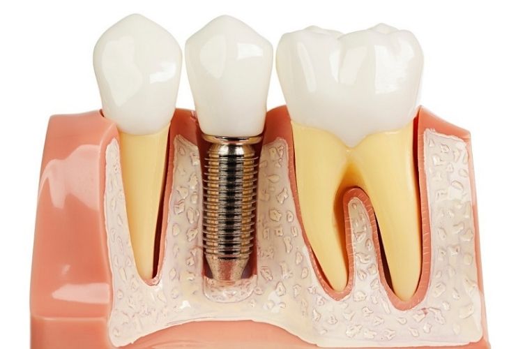 Phương pháp làm răng khểnh bằng trụ Implant