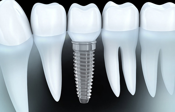 Cấy ghép implant là kỹ thuật có chi phí cao nhất hiện nay