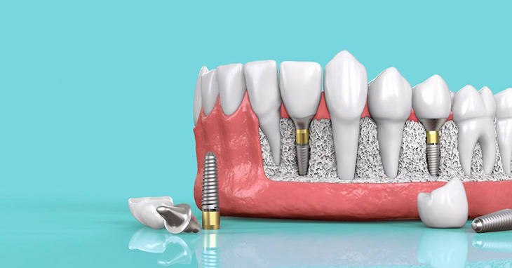 Phương pháp trồng răng nguyên hàm nào tốt nhất? Cấy ghép Implant
