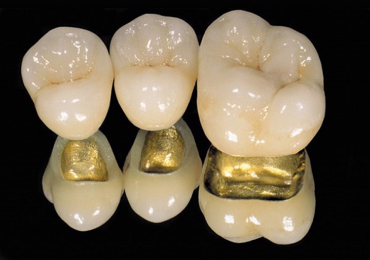 Răng sứ kim loại đá quý có độ bền cao nhưng giá thành khá mắc