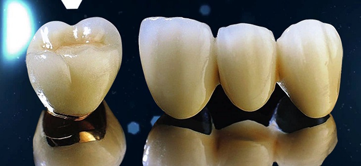 Răng sứ kim loại có tính thẩm mỹ không cao