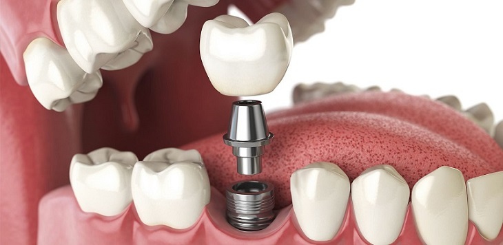 Giá cắm ghép Implant sẽ thay đổi tùy theo số lượng răng cần thực hiện