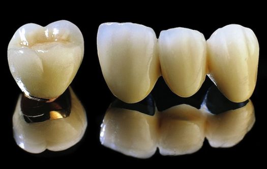 Có nhiều yếu tố khác nhau ảnh hưởng đến chi phí trồng răng sứ titan