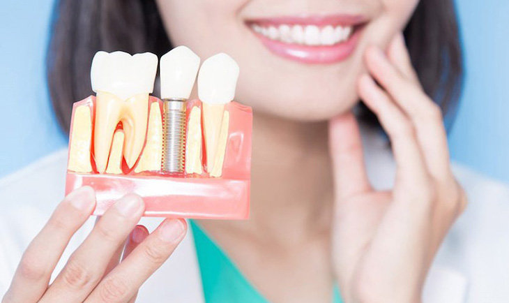 Trồng răng sứ vĩnh viễn được xem là giải pháp phục hình răng hiệu quả