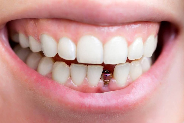 Cấy ghép implant đảm bảo tính chắc chắn, bền bỉ hơn nhiều cho răng giả