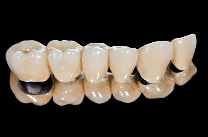 Phân loại các phương pháp trồng răng theo nguyên liệu của trụ và mão răng