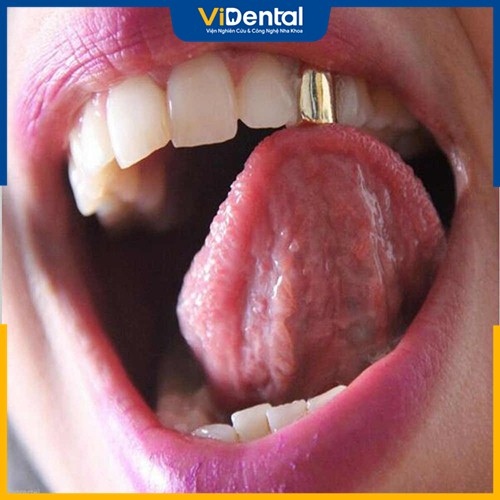 Trồng răng vàng có nhiều ưu điểm được nhiều người yêu thích