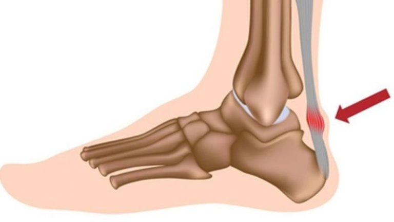 Bệnh nhân bị viêm gân gót chân tuyệt đối không được vận động chân quá mức