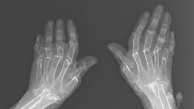 Hình ảnh chụp x-quang khớp bàn tay ở bệnh nhân bị viêm khớp dạng thấp