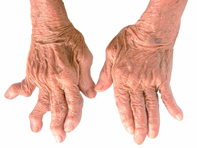Hình ảnh bệnh nhân mắc viêm đa khớp tay