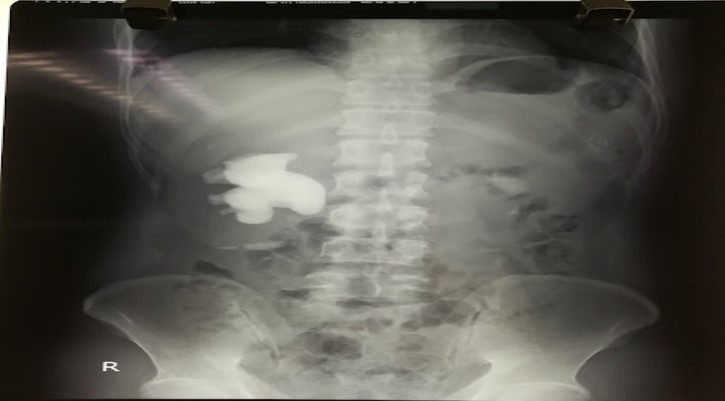 Các bác sĩ có khả năng đối chiếu hình ảnh sỏi thận qua kết quả chụp X-quang